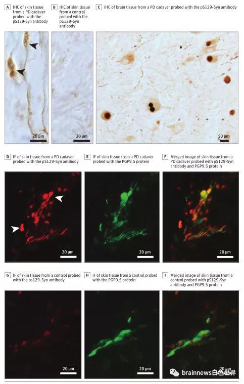 病理性α-syn的免疫组化和免疫荧光结果