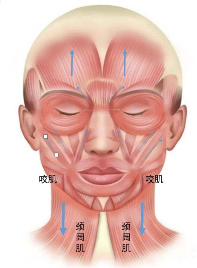 注射肉毒让颈阔肌放松后,肌肉向下拉力减小,下颌缘提升紧致,轮廓也