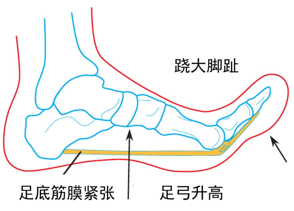 跑鞋越高级越不容易受伤?足底疼痛的最新研究与解决方法