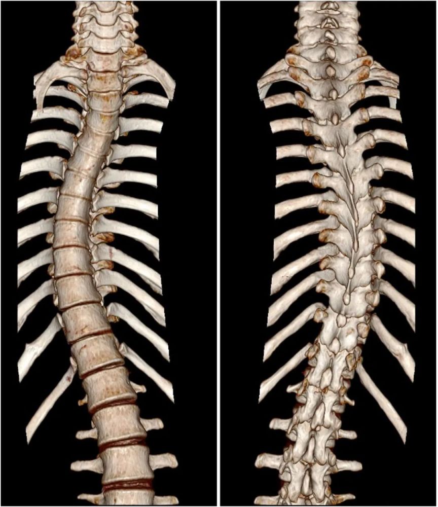 天津市第一中心医院骨科成功完成一例成人特发性脊柱侧弯矫形手术