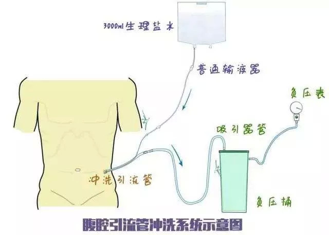 放置双套管,如果发生吻合口瘘可以通过冲洗和低负压吸引保持局部清洁