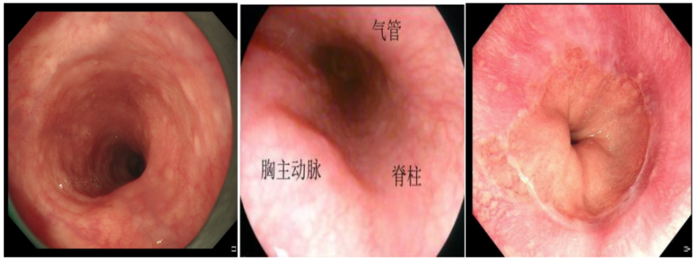 还需要进一步观察贲门部,并做到环齿状线全周的观察