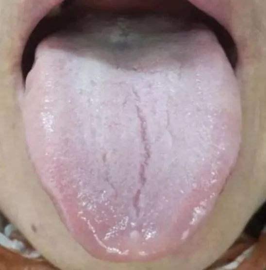 舌头上有裂纹?很可能是疾病信号,发现这3种现象都要及时去医院