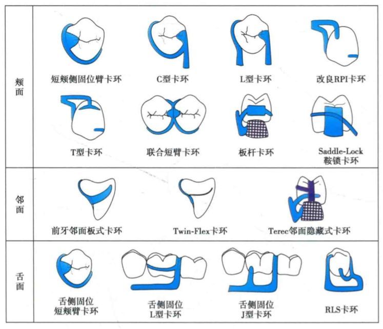 美观卡环修复技术)注意:有时,也可以使用牙色,牙龈