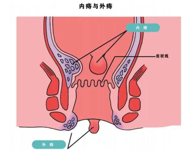 外痔疮消肿的最快方法?痔疮患者福音:一把"痔疮叶",当晚就能消肿止痒