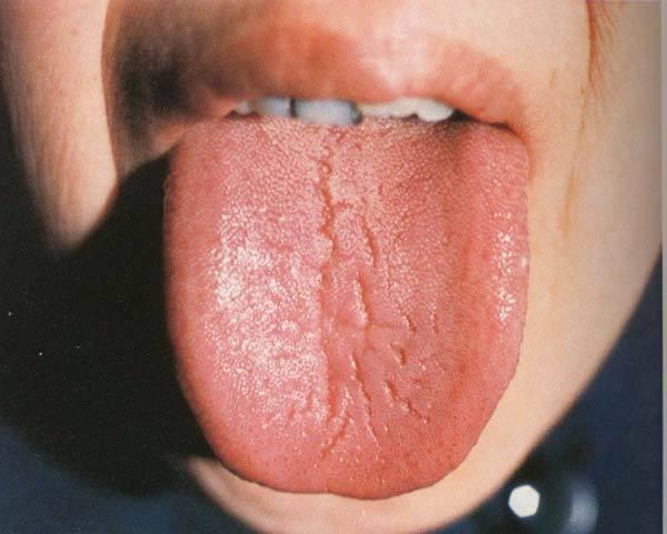 舌头出现裂口子是怎么回事?十有八九是这3种情况,不要