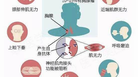 北京重症肌无力科殷世荣:影响重症肌无力康复锻炼?这些你知道吗?