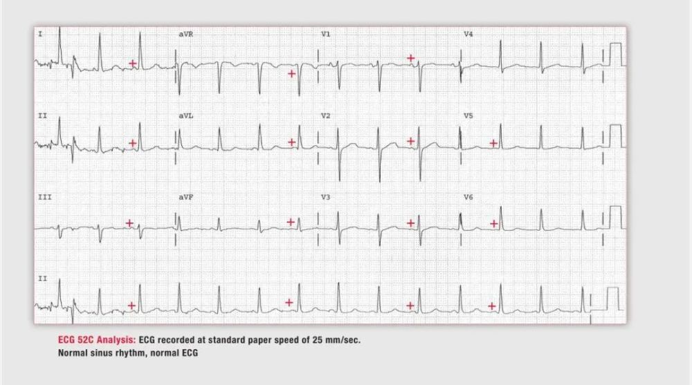 诊断: ecg52c——心电图走纸速度25mm/s,正常窦性心律,正常心电图.