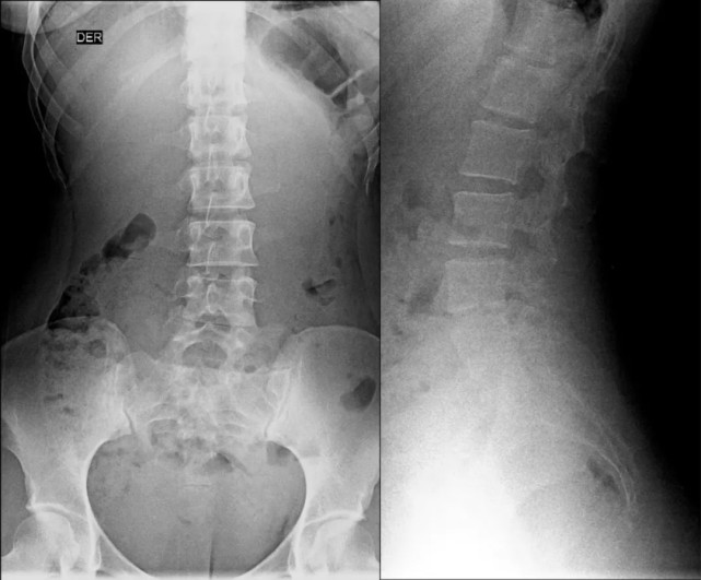腰椎正位片示:l5 椎体双侧横突肥大,为Ⅰb 型; case 3