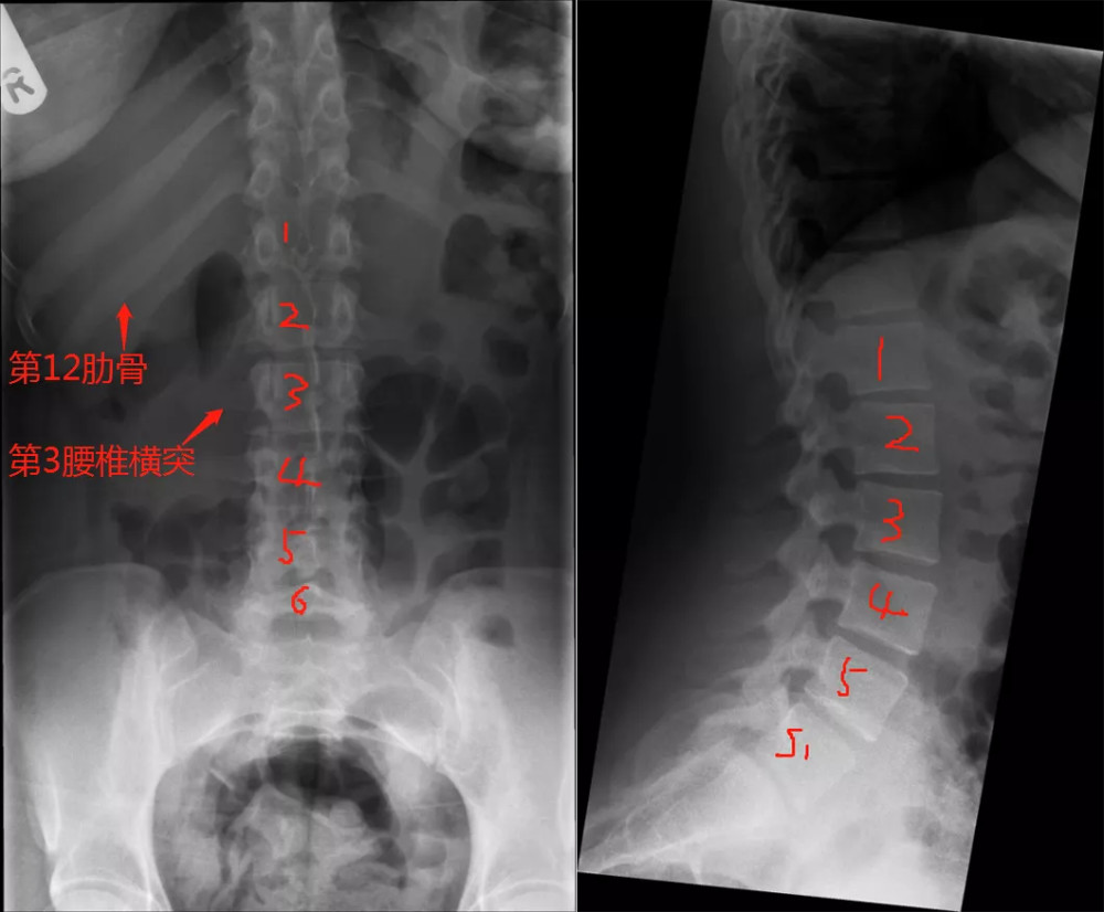 此病例为骶椎腰化 小结 目前,腰骶移行椎以 castellvi 的分类方法最