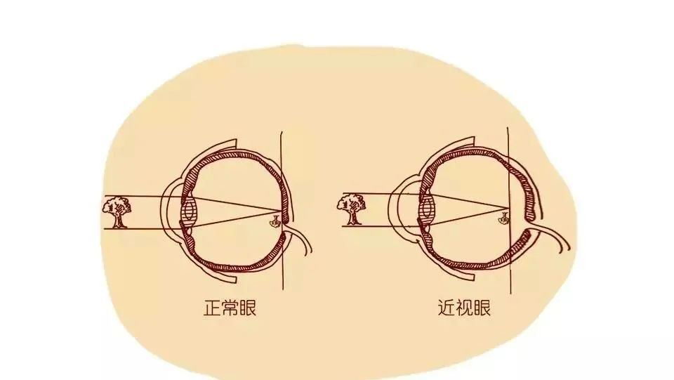 为什么孩子需要定期测眼轴