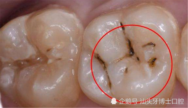 1,浅龋—有黑线,但是不痛不痒蛀牙,又称龋(qu,第三声)齿,根据蛀牙的