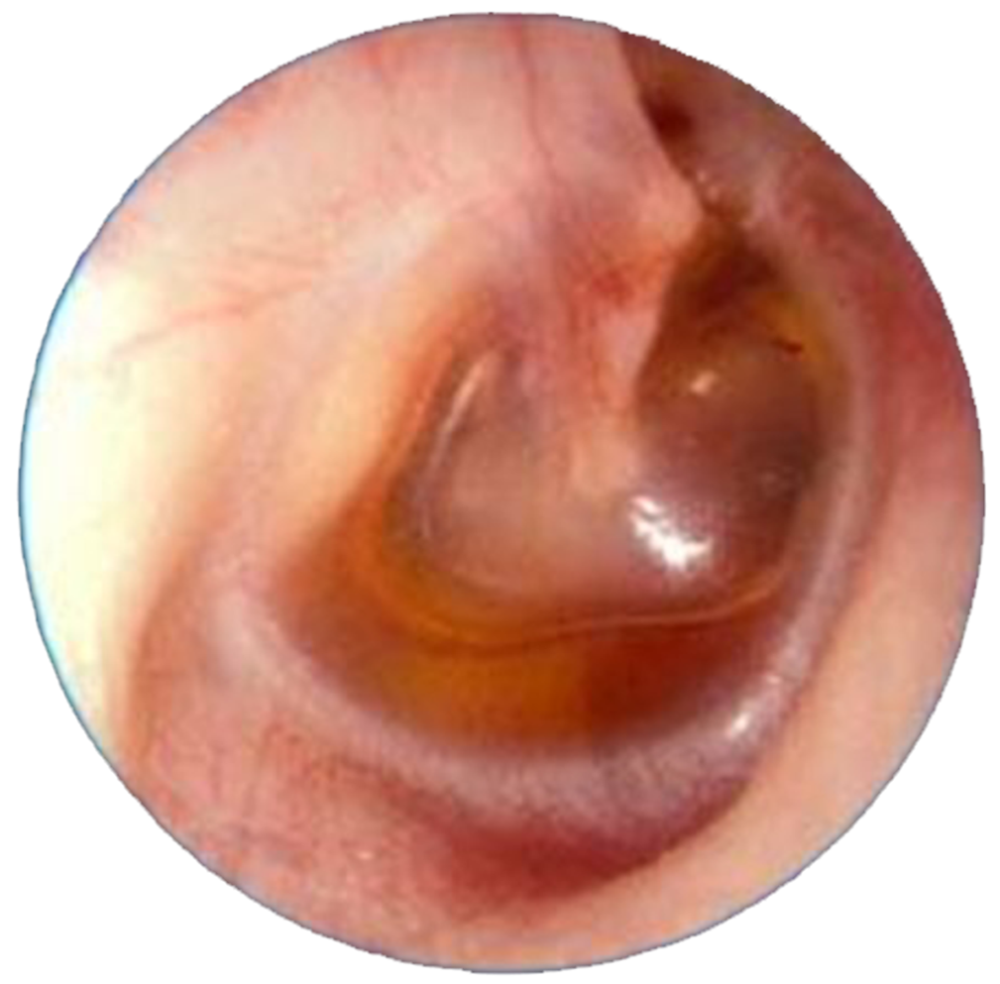 中耳积液,并伴随急性充血的情况,但 鼓膜完整;而急性化脓性中耳炎症状