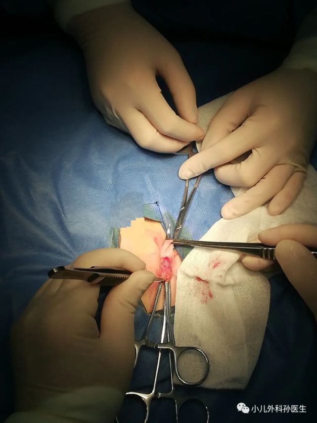 sun|再谈小儿腹股沟斜疝和鞘膜积液的开放手术和腹腔镜手术
