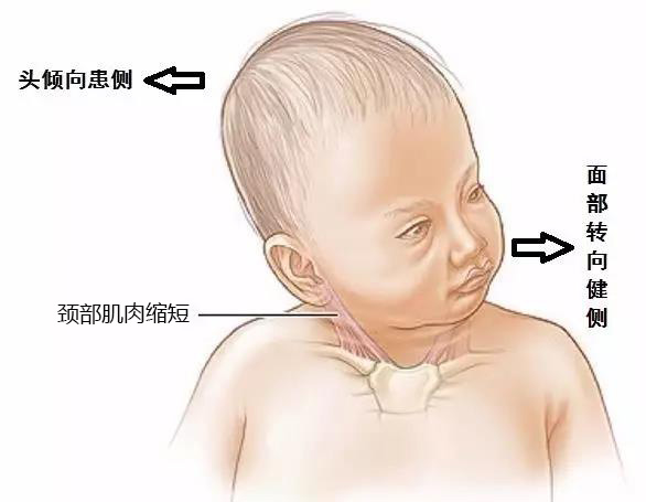 如果宝宝经常性头往一侧偏,竖抱着,躺着的时候也会歪向一