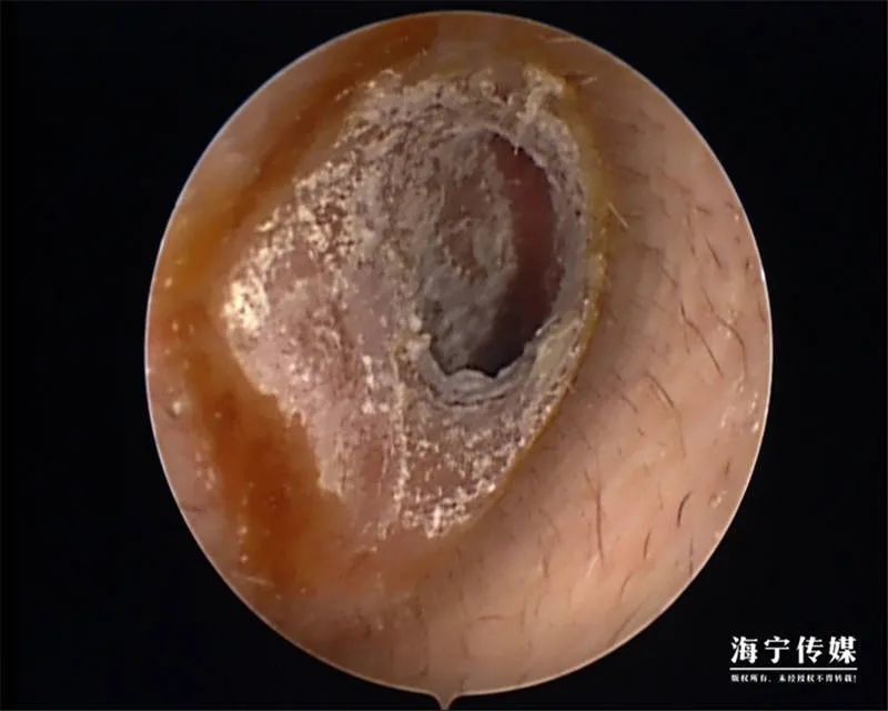 医生检查发现,他的 双侧耳道表面布满密密麻麻的白色绒毛物体,被诊断