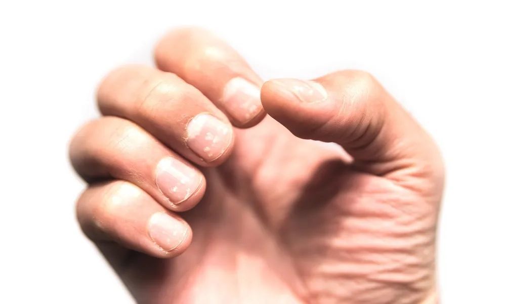 月牙少是身体差?医生:指甲上出现这4种异常,才是生病的信号