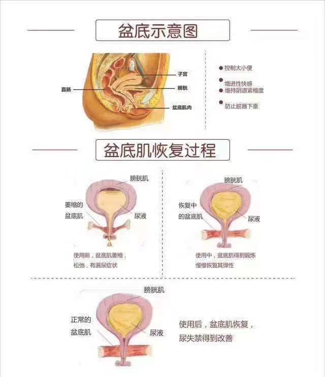 顺产和剖腹产多久后可以做盆底肌修复