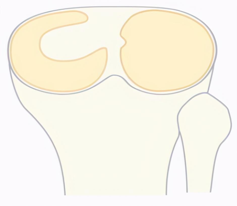医生跟你聊聊半月板的故事