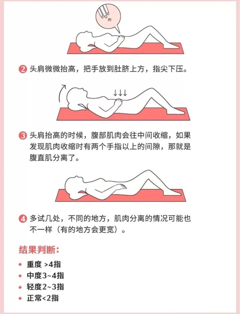 产后腹直肌分离大肚腩如何正确认识腹直肌分离满满干货
