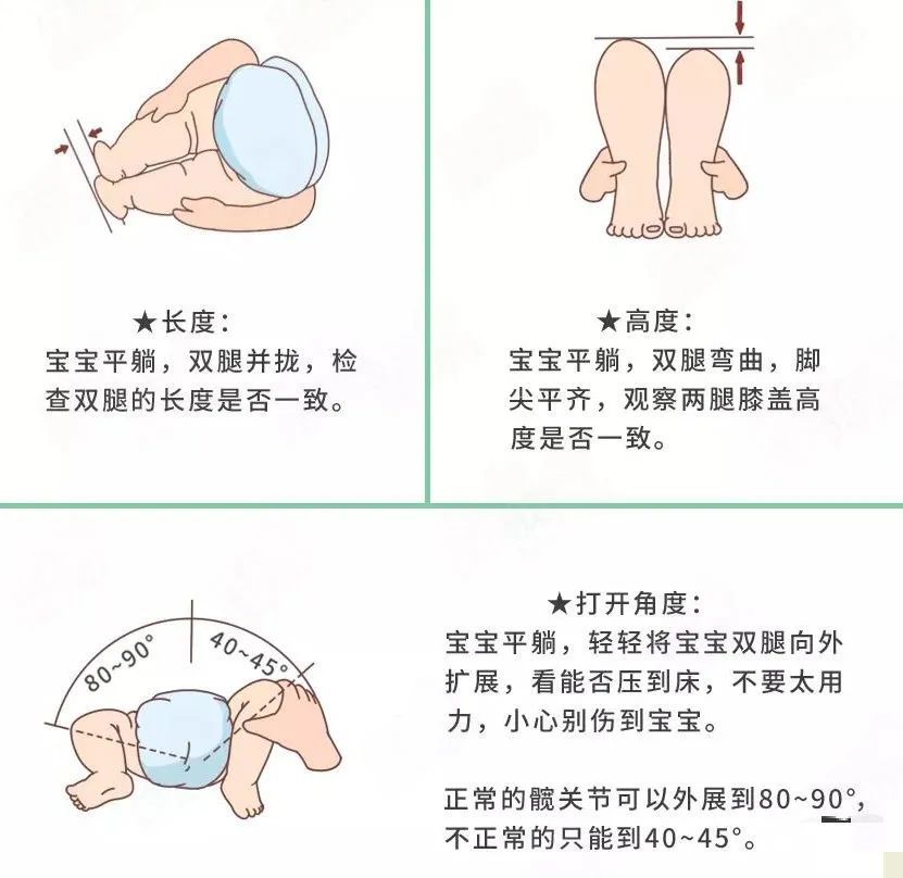 髋关节发育不良属于一种骨科疾病,可能会影响到宝宝正常走路.