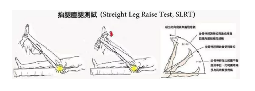 梨状肌综合征症状缓解