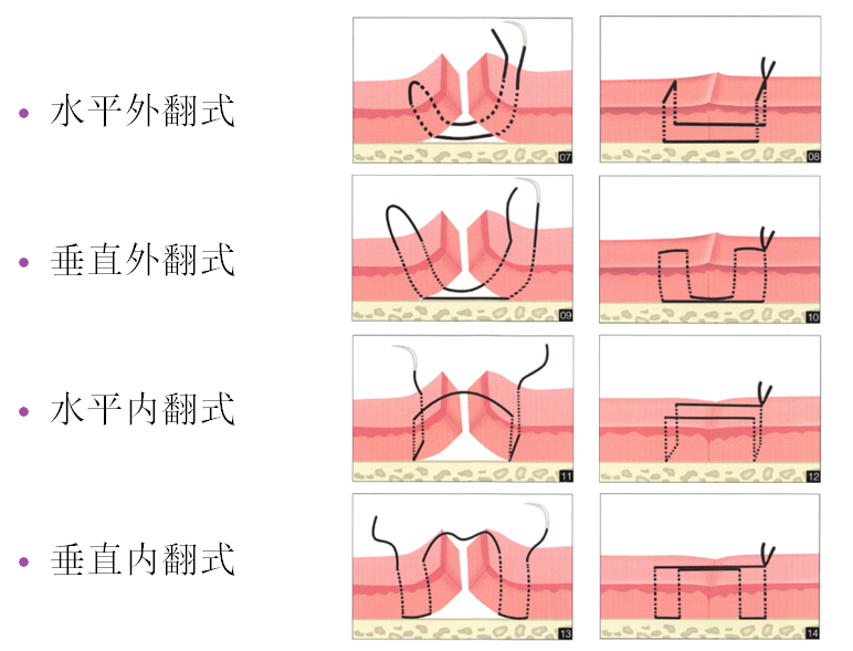 口腔外科常用的缝合技术