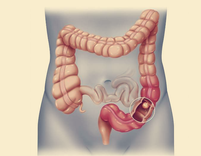 大肠,结肠傻傻分不清?科普一下你不知道的大肠癌,3类人要警惕