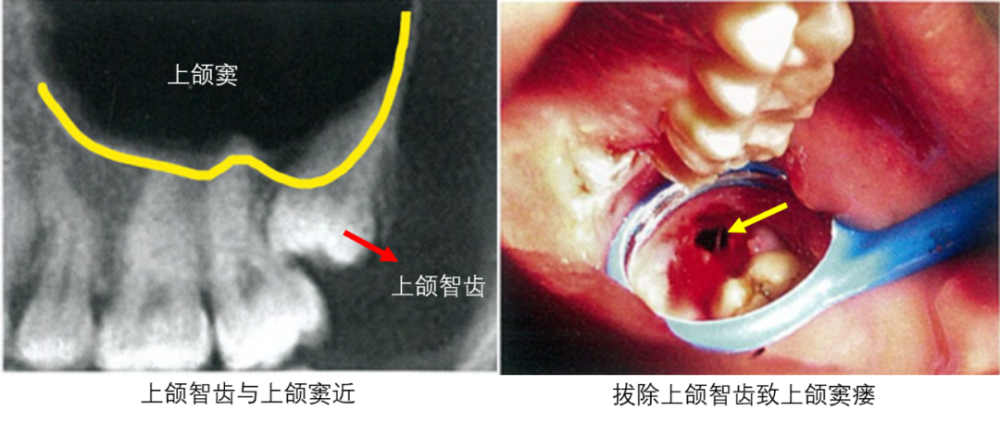 上颌智齿: 如果拔牙比较暴力,智齿离上颌窦非常近或者一部分牙根已经
