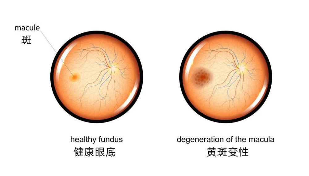 常见的眼底病变有:视网膜脱离,玻璃体混浊,黄斑劈裂,黄斑裂孔,玻璃体