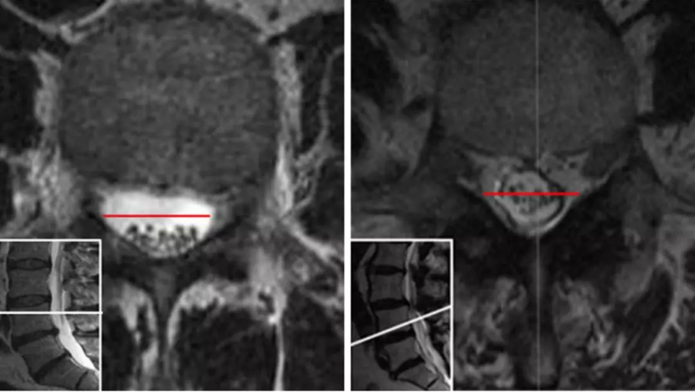mri提示腰椎管狭窄症的几个特殊征象,你肯定忽视过!