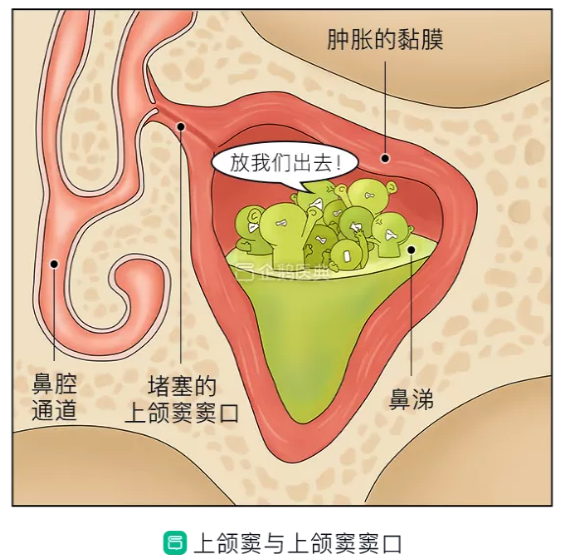 过敏性鼻炎反复发作,使得鼻腔黏膜持续水肿,堵塞鼻窦腔在鼻腔的开口