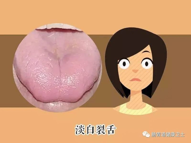 从舌质看体质:舌头开裂,有齿痕,分别暗示了什么问题?