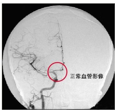 烟雾病是一种脑血管疾病,是一种异常的脑底脑血管网病变