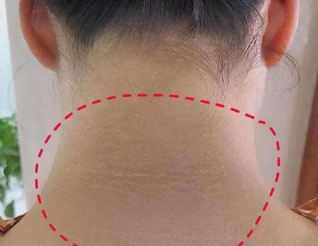 却怎么洗不干净,其实大多都是肥胖导致的,属于假性黑棘皮病他得意地说