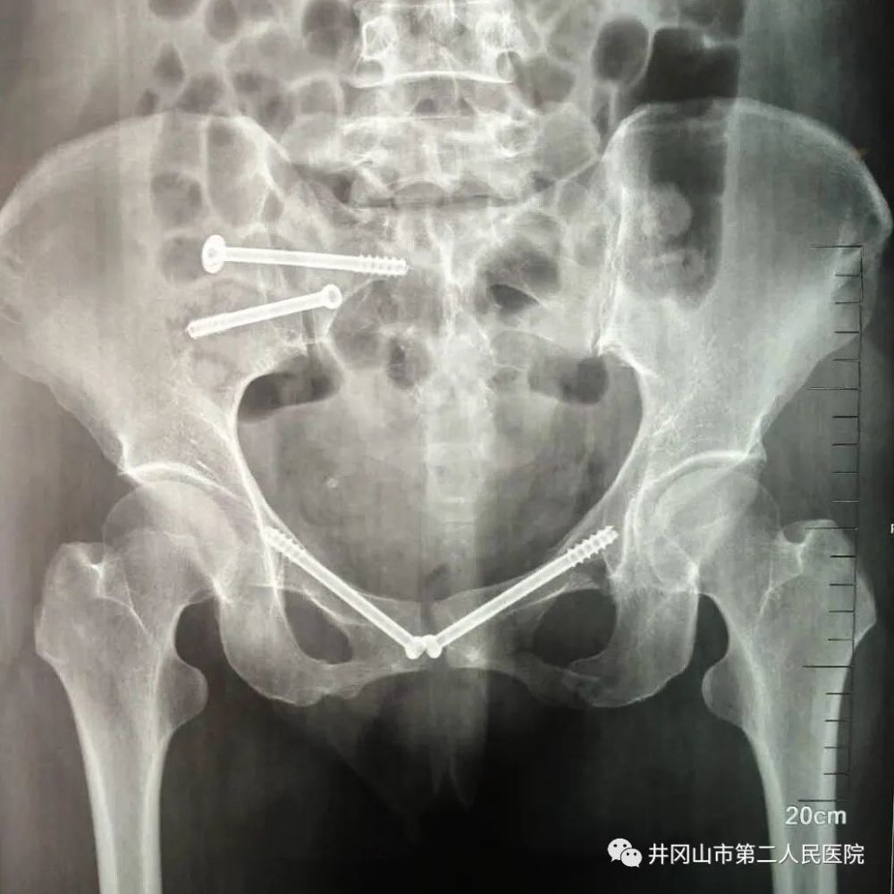 手术案例二 谢某,男,外伤致十二胸椎压缩性骨折,骶骨骨折,腰5椎体横