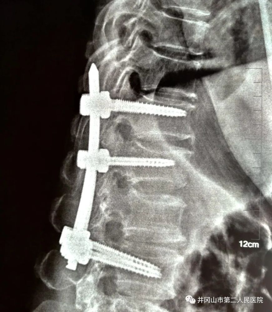 男,外伤致十二胸椎压缩性骨折,骶骨骨折,腰5椎体横突骨折,骨盆左侧