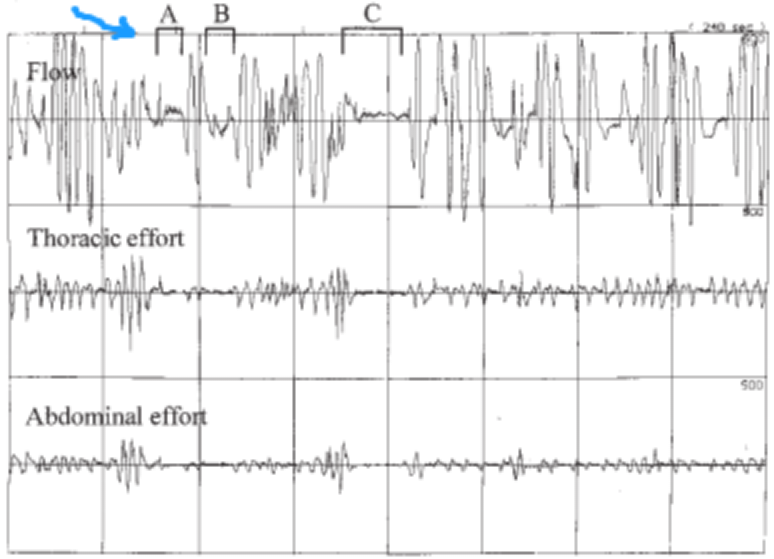 a图标为多导睡眠仪(psg))捕捉中枢性呼吸暂停