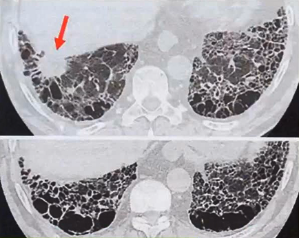 详解肺纤维化合并肺气肿丨果断收藏!