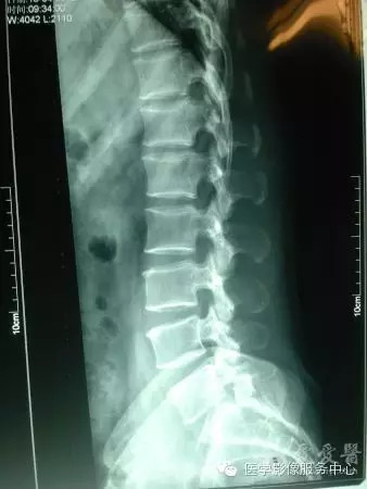 骶椎腰化腰椎骶化腰椎滑脱腰肌劳损简单易懂图解