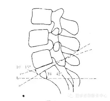 国内著名骨放射学家杨世埙教授指导过,只要大家留意关注腰椎横突"三长