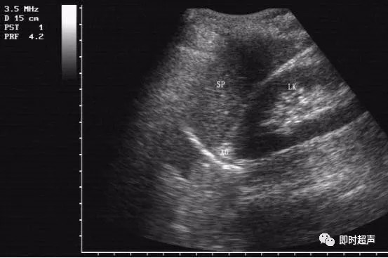 超声诊断解剖基础之脾脏