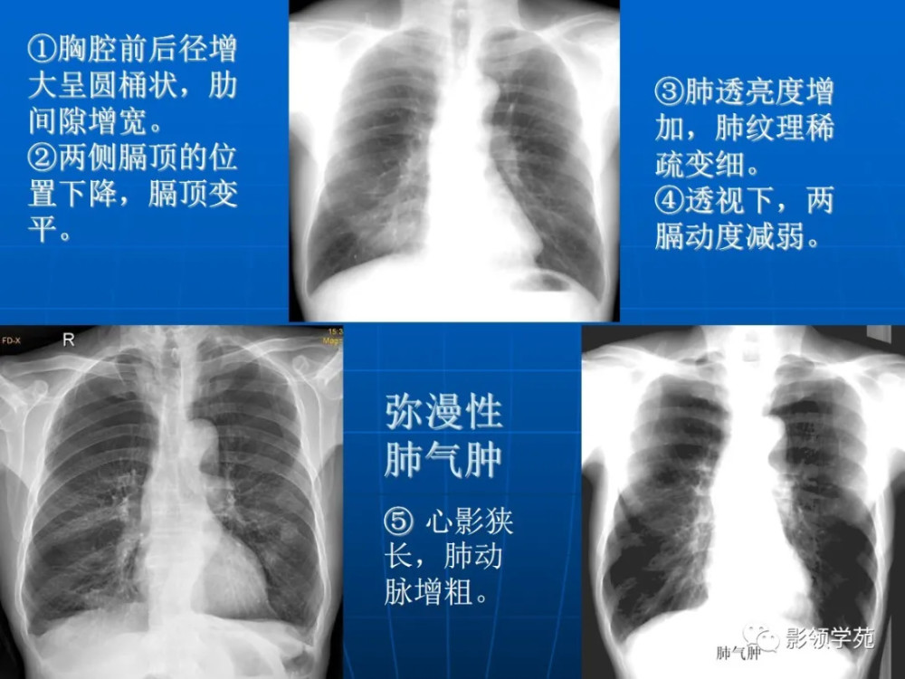 肺气肿的影像诊断