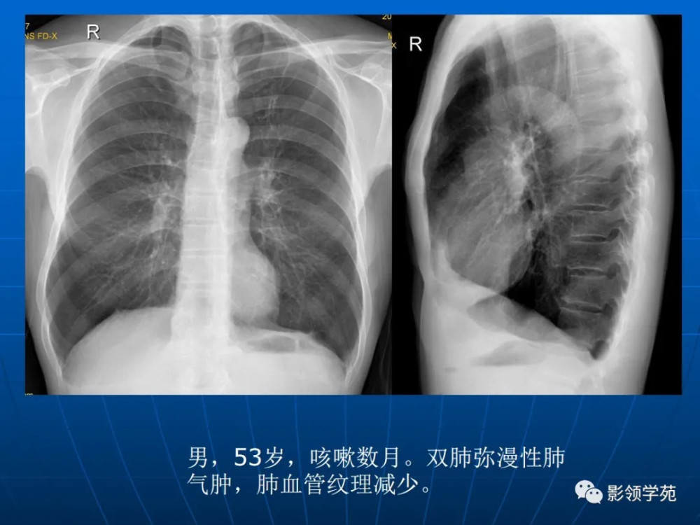 肺气肿的影像诊断