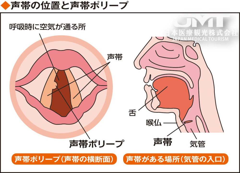 声带的位置和声带息肉