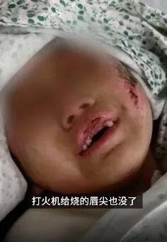 辽宁6岁女童被亲妈及其男友虐待,烫水浇头掰碎胳膊!