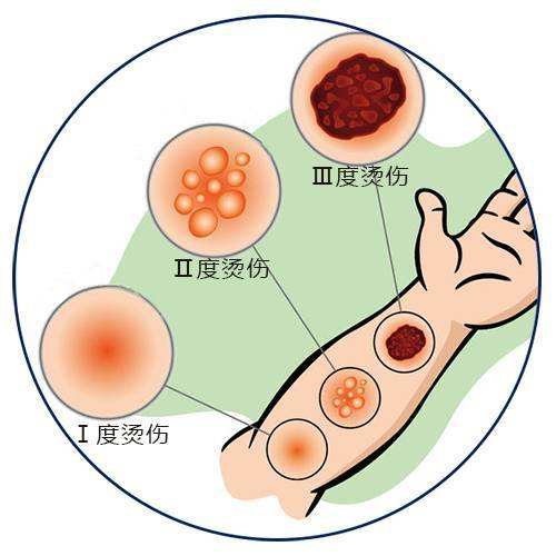 天冷热水泡脚小心低温烫伤