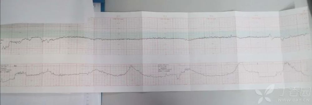 电子胎心监护微小变异,剖还是顺?要如何抉择?