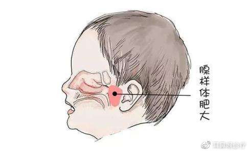 儿童腺样体肥大该怎么办呢?