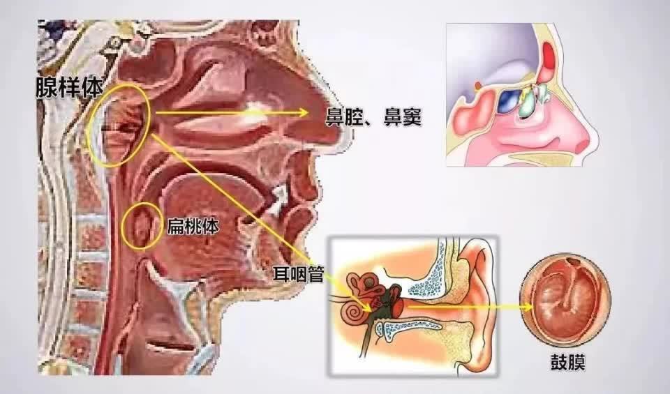 扁桃体,腺样体反复发炎要不要摘?